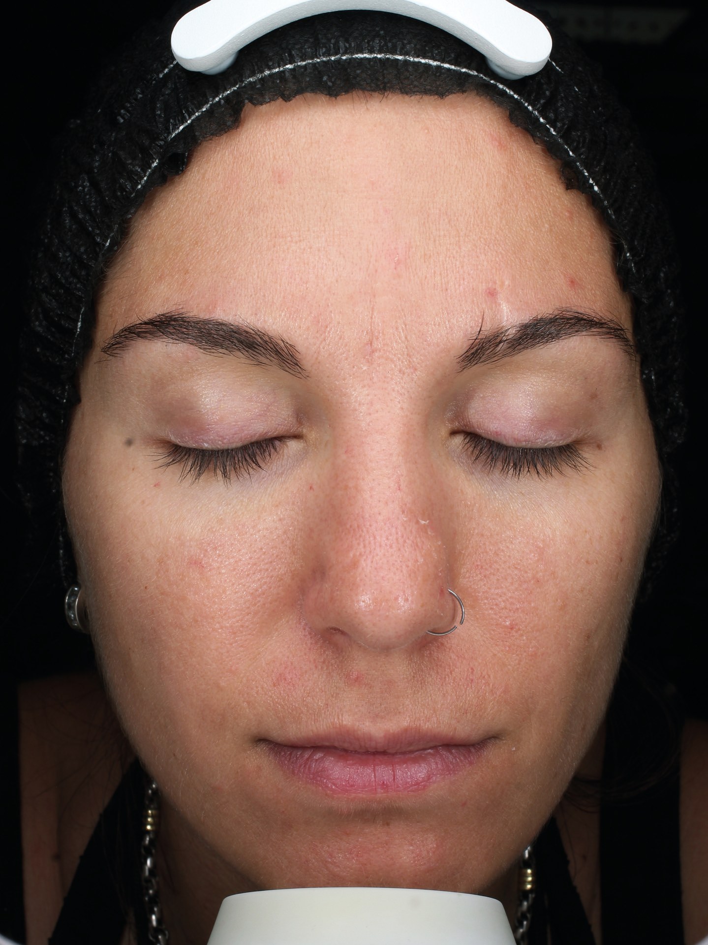 The same volunteer's skin after the CLEARIST CTX protocol