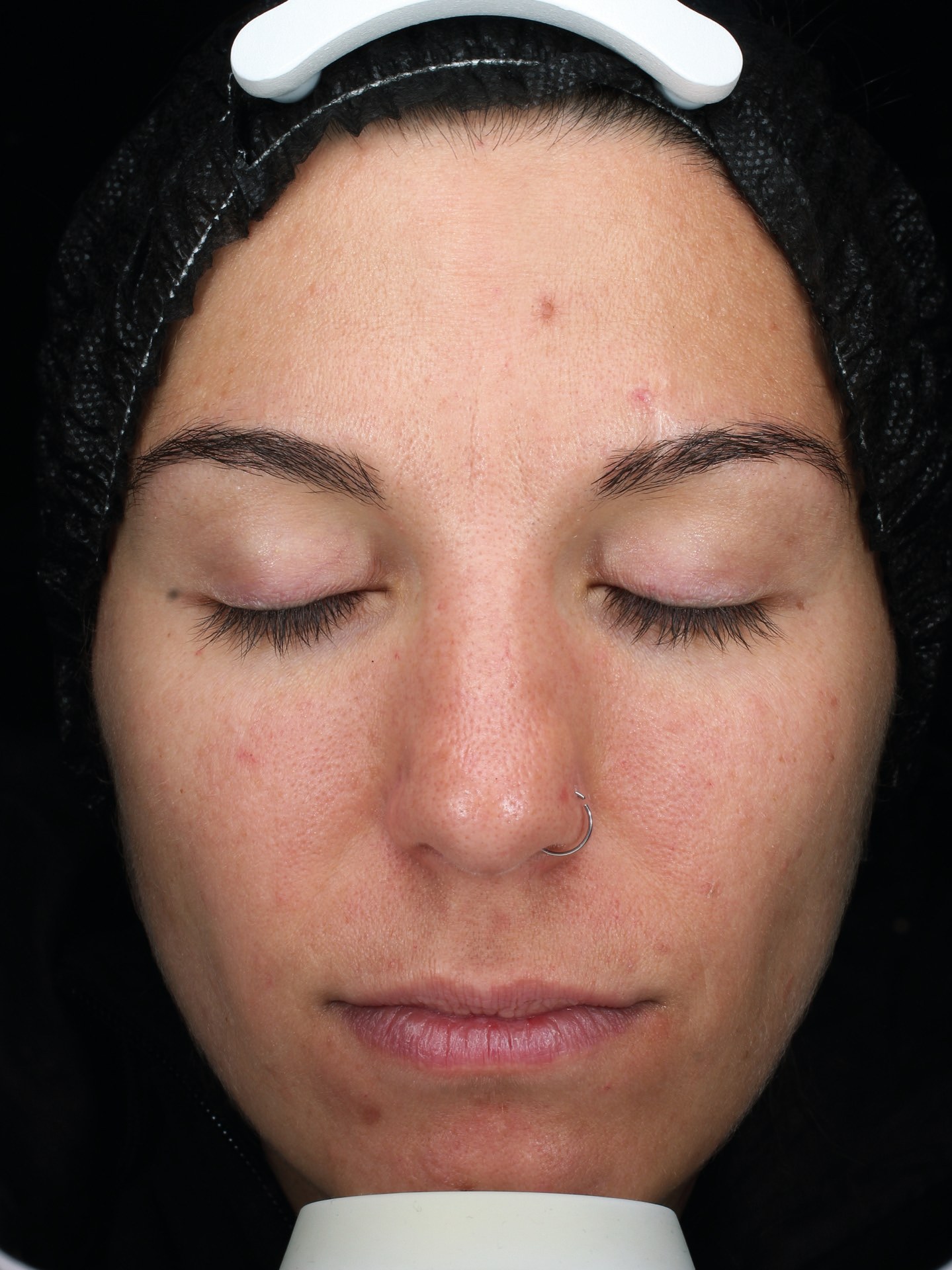 A study volunteer's skin before the CLEARIST CTX protocol