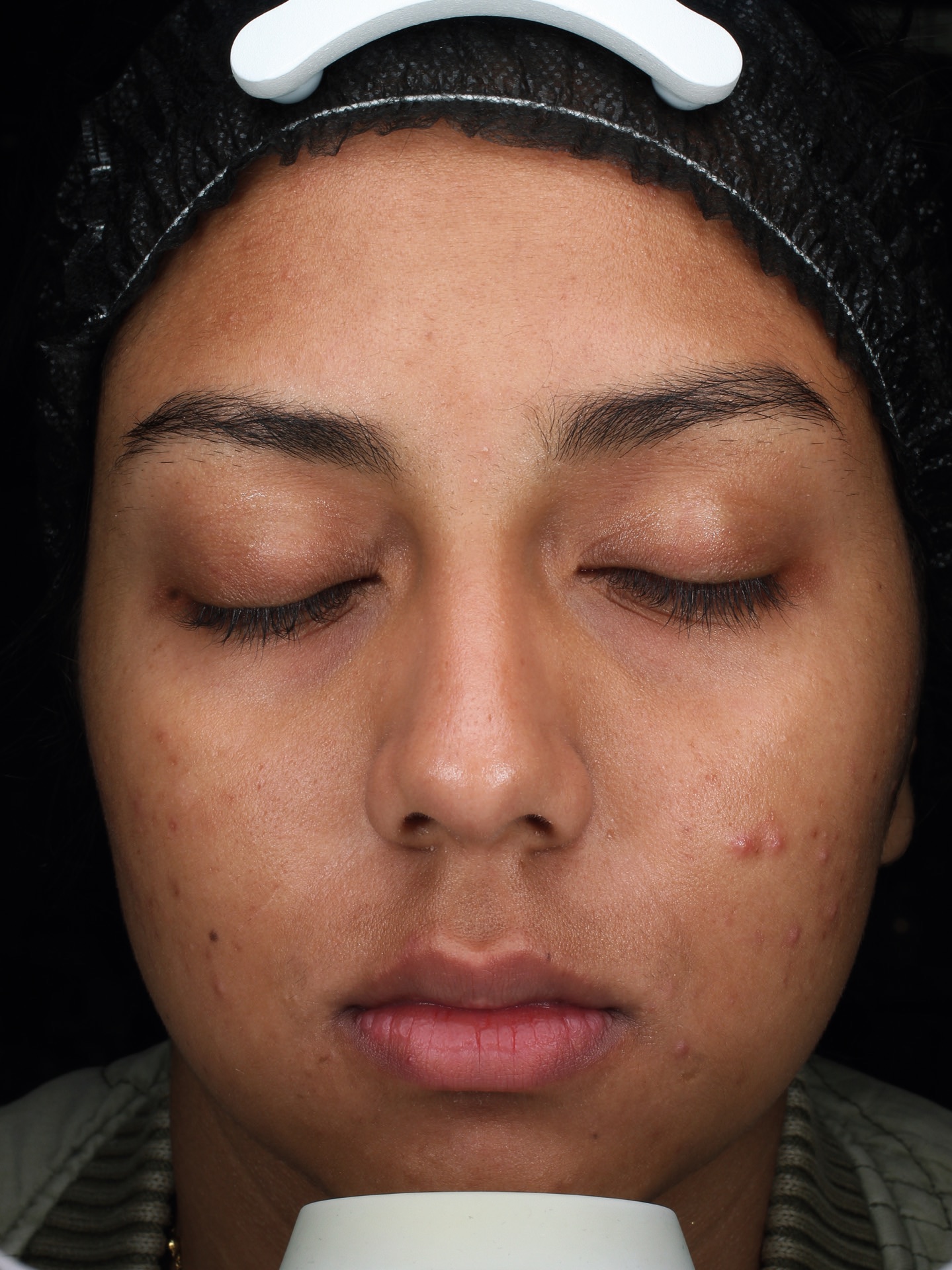 Skin before the CLEARIST CTX protocol